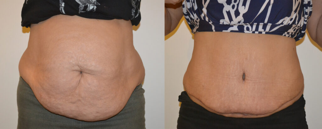 About Abdominoplasty