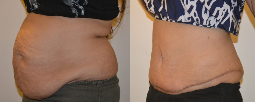 About Abdominoplasty