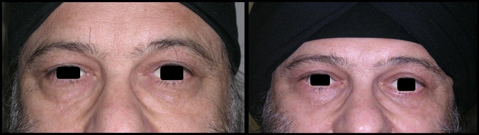 About Otoplasty