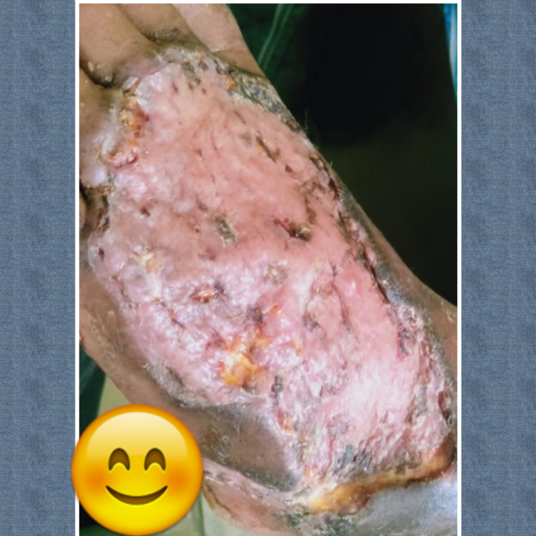 About Abdominoplasty
