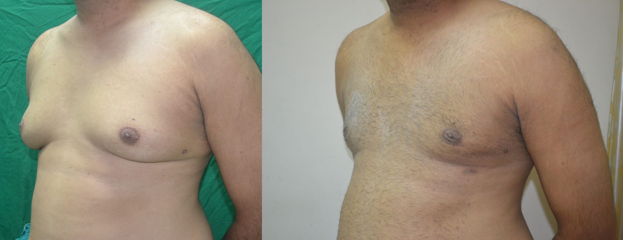 About Abdominoplasty