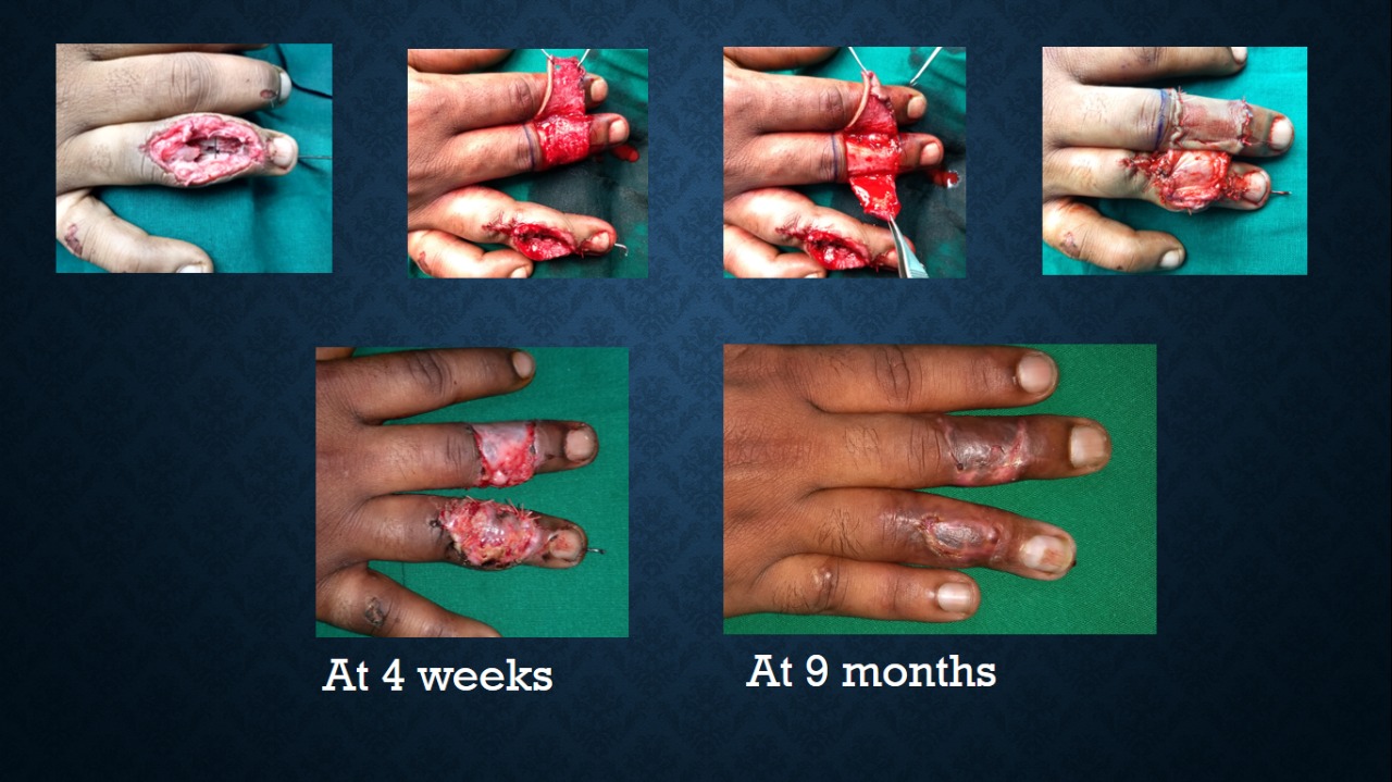 About Otoplasty