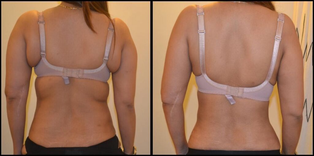 About Liposuction
