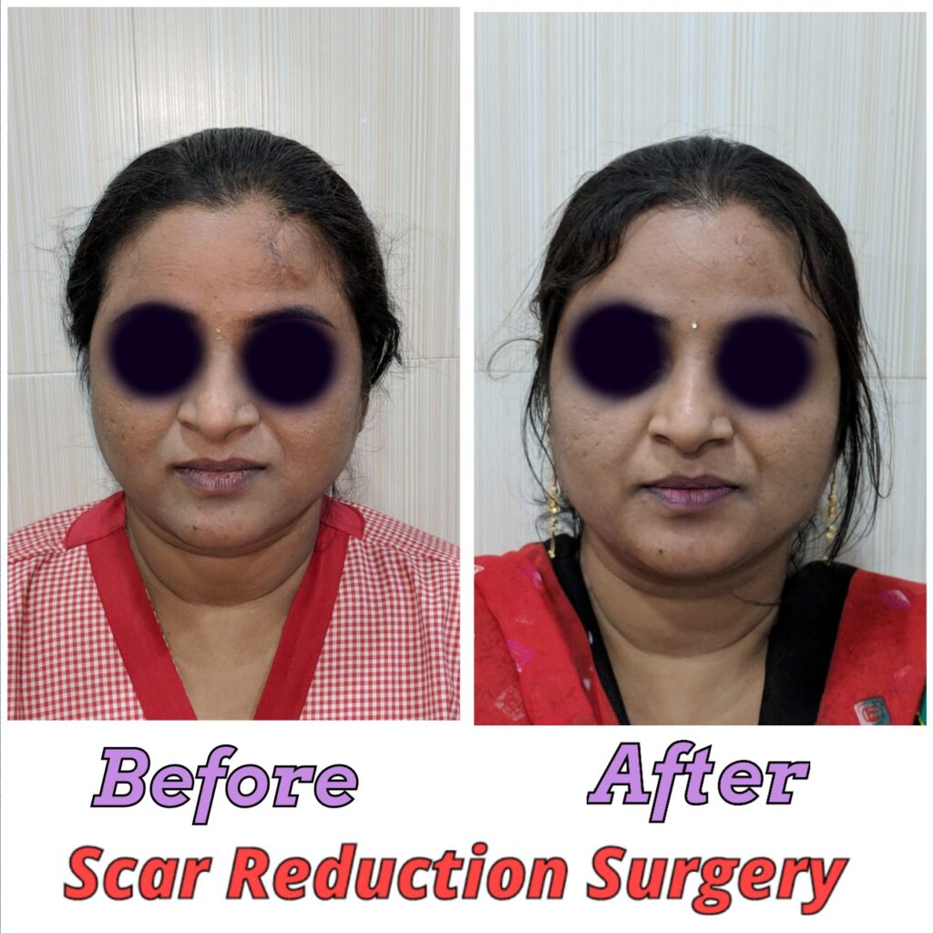 About Otoplasty