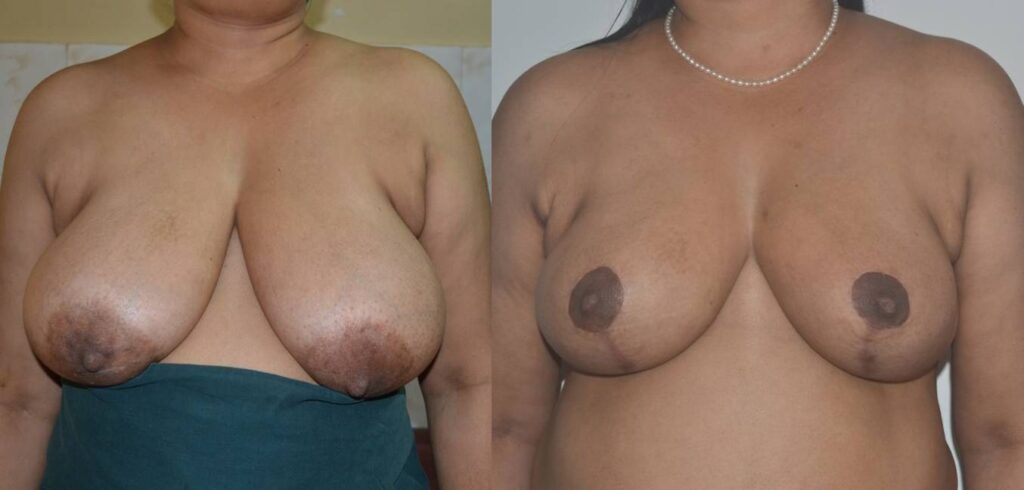 About Abdominoplasty