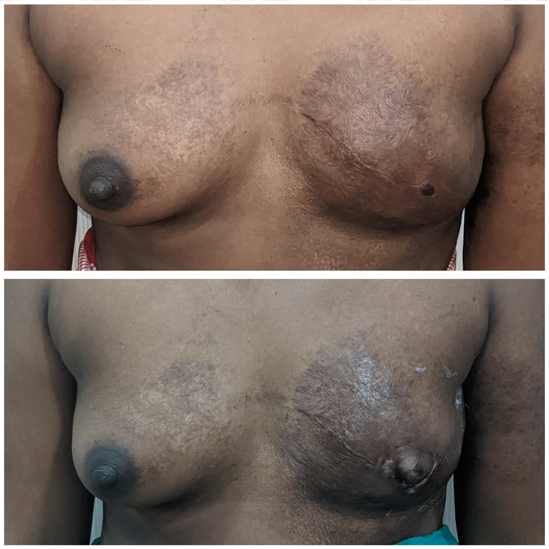 Burn Care Patient 1 - Case 1