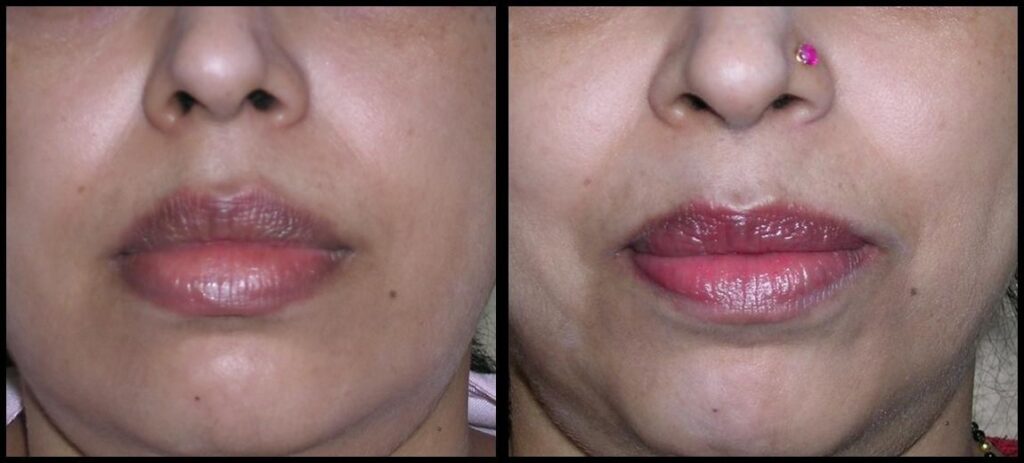 About Otoplasty